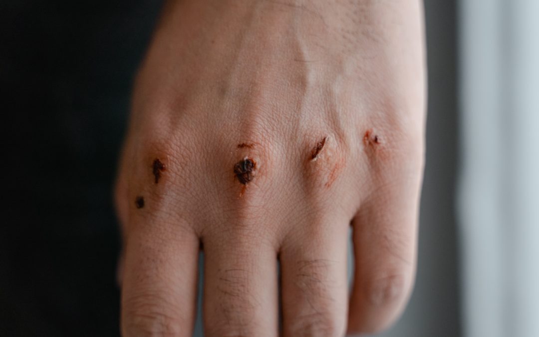 Self-harm – Here’s How You Can Help Yourself